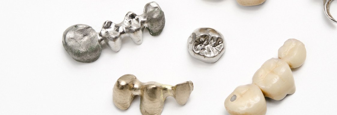 Zahngold-Ankauf DIGOSI, Zahnkronen, Brücken oder Inlays werden von Patienten, Zahnarztpraxen oder Dentallaboren verkauft oder recycelt.
